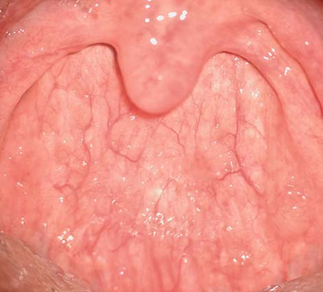 正常の咽頭後壁粘膜